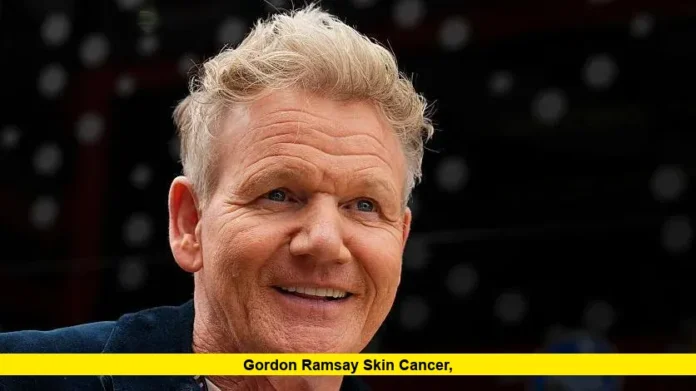 Gordon Ramsay Skin Cancer, Gordon Ramsay Skin Cancer