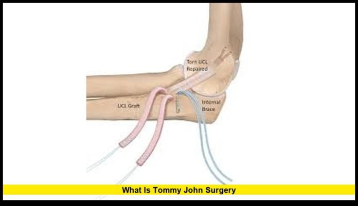 What is Tommy John surgery