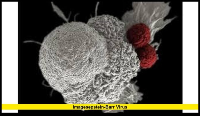 Epstein Barr virus