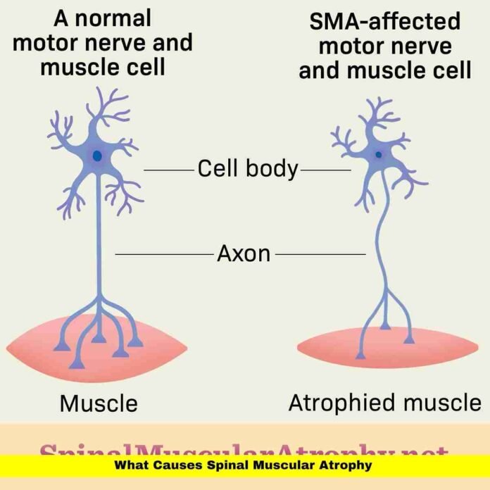 What Causes Spinal Muscular Atrophy