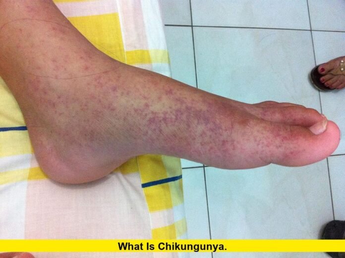 What Is Chikungunya. What Is Chikungunya