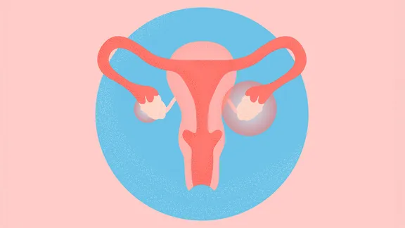 Renamed PMOS in Major Women’s Health Shift That Could Change Diagnosis and Treatment