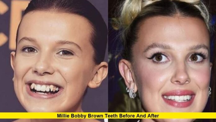 Millie Bobby Brown Teeth Before and After