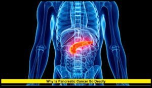 Why is pancreatic cancer so deadly