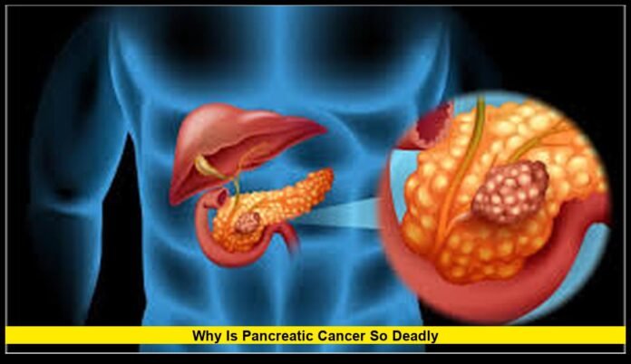 Why is pancreatic cancer so deadly Why is pancreatic cancer so deadly