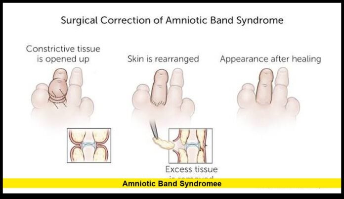amniotic band syndromeE Causes, Diagnosis, Treatment and Pregnancy Outlook