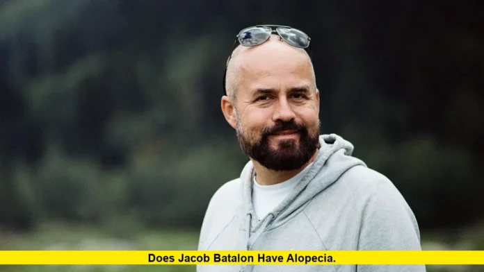 Does Jacob Batalon Have Alopecia