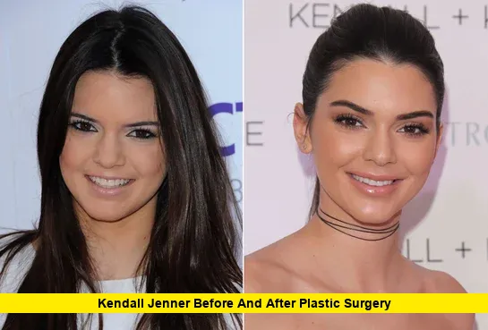 Kendall Jenner Before and After Plastic Surgery